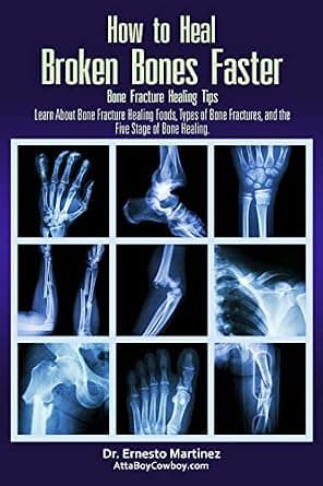 How to Heal Broken Bones Faster. Bone Fracture Healing Tips: Learn About Bone Fracture Healing Foods, Types of Bone Fractures, and the Five Stages of Bone Healing (Health and Welln image